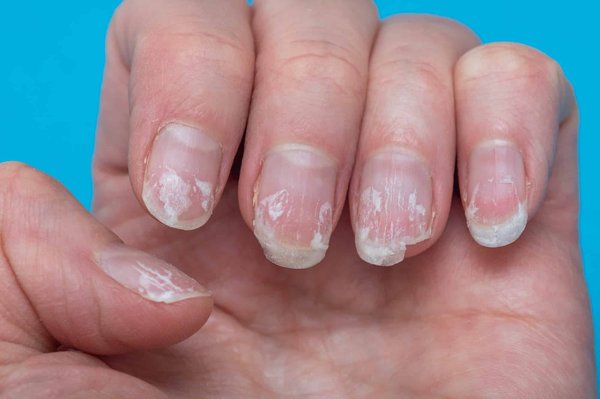 Guide de survie pour ongles abîmés: Retrouver éclat et santé